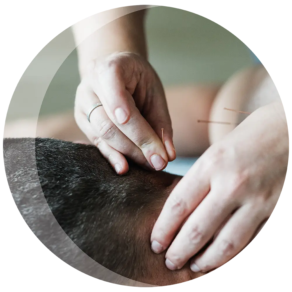 Detailfoto wie Akupunkturnadeln in den Nacken gesetzt werden